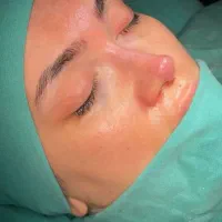 ماموپلاستی لیپوابدو جراحی بینی