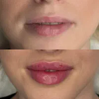 خدمات زیبایی ،فیلر، ژل،بوتاکس توسط پزشک با تجربه