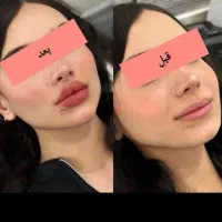 فیلر بادی(هیپ دیپ،بیکینی،ساق)محصولات سفیدکردن پوست