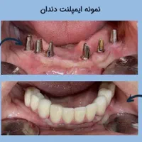 ایمپلنت تخصصی دندانپزشکی توسط ایمپلنتولوژیست فارس|خدمات آرایشگری و زیبایی|شیراز, قصرالدشت|دیوار