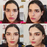 جراحی های زیبایی لیفت شقیقه ابرو صورت غبغب پلک