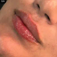 مدل ژل و بوتاکس