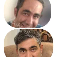 کاشت دائمی مو و ابرو