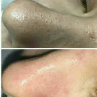 تخفیف ویژه پاکسازی پوست ده مرحله ای
