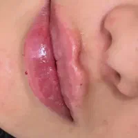 خدمات تزریق فیلر ،بوتاکس،آنزیم ،پیرسینگ،چال گونه