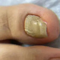 خدمات ارتونیل(ارتودنسی ناخن)وکفسابی ،درمان میخچه|خدمات آرایشگری و زیبایی|تهران, دردشت|دیوار