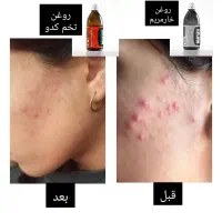 طب سنتی|آرایشی، بهداشتی، درمانی|انگوران, |دیوار