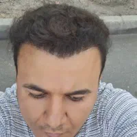 کاشت مو و ابرو با جدیدترین متدهای روز|خدمات آرایشگری و زیبایی|تبریز, |دیوار