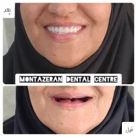 دندانسازی دندانساز دندان مصنوعی دندان باضمانت|آرایشی، بهداشتی، درمانی|مشهد, کوشش|دیوار