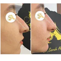 اصلاح فرم و کوچک کردن بینی توسط پزشک بدون جراحی|خدمات آرایشگری و زیبایی|قم, دورشهر|دیوار