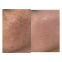 فیشال تخصصی.پاکسازی.کربوکسی.پلاژن تراپی.اسیدتراپی|خدمات آرایشگری و زیبایی|مشهد, انقلاب|دیوار