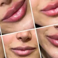تزریق ژل،بوتاکس،پی آرپی،مزو تراپی،پلاسما جت|خدمات آرایشگری و زیبایی|بندر امام خمینی, |دیوار