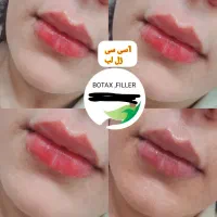ژل،بوتاکس،تاتو،شیدینگ لب