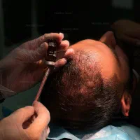 مزوتراپی تخصصی تقویت و رشد مو PRP و هیرفیلر