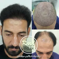 کاشت مو طبیعی سر و ابرو و ریش با ضمانت نامه کتبی