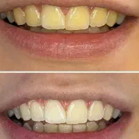 بلیچینگ.جرم گیری