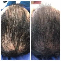 درمان ریزش مو،مزوتراپی