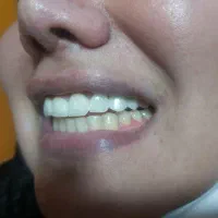 عصبکشی پر کردن ۱۳۰۰ روکش فروش رادیوگرافی