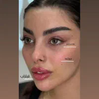 ژل لب مادلینگ کانتورینگ بوتاکس فیلرزیرچشم فیلربادی|خدمات آرایشگری و زیبایی|تهران, سید خندان (جلفا)|دیوار