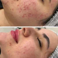 فیشال و‌لیزر موهای رائد