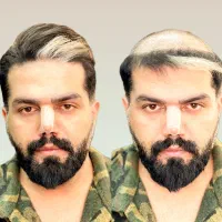 مرکز تخصصی پروتز مو اصفهان