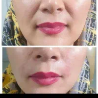 ژل و بوتاکس