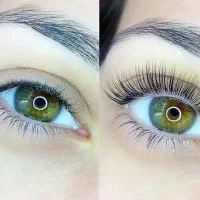 لیفت شقیقه با لیفت ابرو