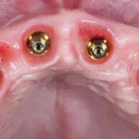 دندانپزشکی اوردنچر دو فک فقط ۱۰۰ تومن|خدمات آرایشگری و زیبایی|هریس, |دیوار