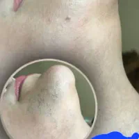 40% تخفیف لیزر موهای زائد