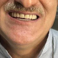 ساخت و تعمیر دندان مصنوعی طرح لمینت