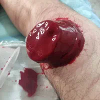 حجامت، زالودرمانی،بادکش درمانی در پرند|خدمات آرایشگری و زیبایی|پرند, فاز ۵|دیوار