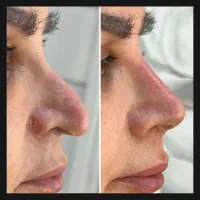 تکنیک آواتار تک جلسه بدون جراحی وبازگشت توسط پزشک