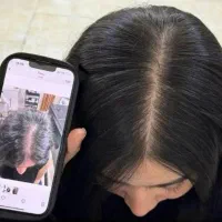 درمان تصمینی ریزش مو