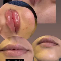 تزریق ژل وجوانسازی تخصصی ومزو ژل،بوتاکس|خدمات آرایشگری و زیبایی|شاهین‌شهر, فردوسی|دیوار