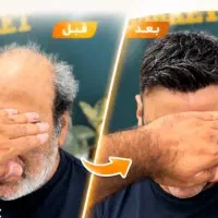 پروتزموپرپشتی مو بدون عمل و دردوخونریزی باضمانت|خدمات زیبایی و سلامت|اصفهان, گلزار|دیوار