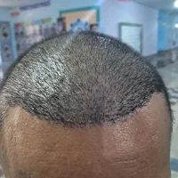 کاشت مو و‌ ابرو با طراحی اختصاصی و پی آر پی تخصصی