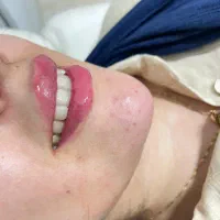 لیزر ژل وبوتاکس وخالبرداری سم زدایی