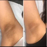 انجام ریموو تتو و روشن کنندگی نواحی تیره ه بدن