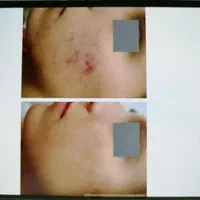 سفید سازی بکینی، جوانسازی پوست پیلینگ(کربن تراپی)|خدمات آرایشگری و زیبایی|مشهد, فرهنگیان (شهرک غرب)|دیوار