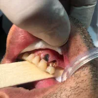 دندان پزشکی دندان سازی|خدمات آرایشگری و زیبایی|قائم‌شهر, |دیوار