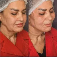 تخفیف عالی تزریق ژل،بوتاکس،نخ،هایفو،لیزرلاغری پزشک