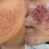 پاکسازی و فشیال
