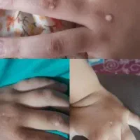 بهبودی ززگیل و تبخاال تظمینی|آرایشی، بهداشتی، درمانی|آبادان, |دیوار