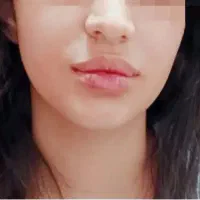 تزریق ژل وبوتاکس ژل لب گونه چانه زاویه خط لبخند|خدمات آرایشگری و زیبایی|کرمانشاه, |دیوار