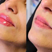 فیلر لب با بهترین کیفیت|خدمات آرایشگری و زیبایی|تهران, شهرک آزمایش|دیوار