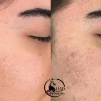 جشنواره ،مزوتراپی مو و ابرو، هیرفیلر، رفع اسکار