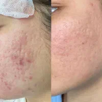 اف ژل لب وآف بوتاکس درمطب پزشک|خدمات آرایشگری و زیبایی|مشهد, احمدآباد|دیوار