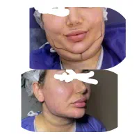 زاویه سازی فک وچربی|خدمات زیبایی و سلامت|اهواز, کیانپارس |دیوار