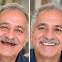 دندان مصنوعی ژلهای انعطاف پذیر تحویل فوری|خدمات زیبایی و سلامت|تهران, فردوس|دیوار