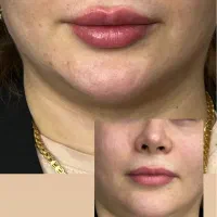 اف فقط فردا مدل تکمیل البوم(ژل بوتاکس پی ار پی)